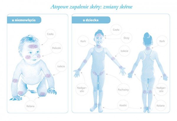 Atopowe zapalenie skóry